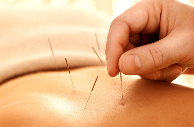Acupuncture