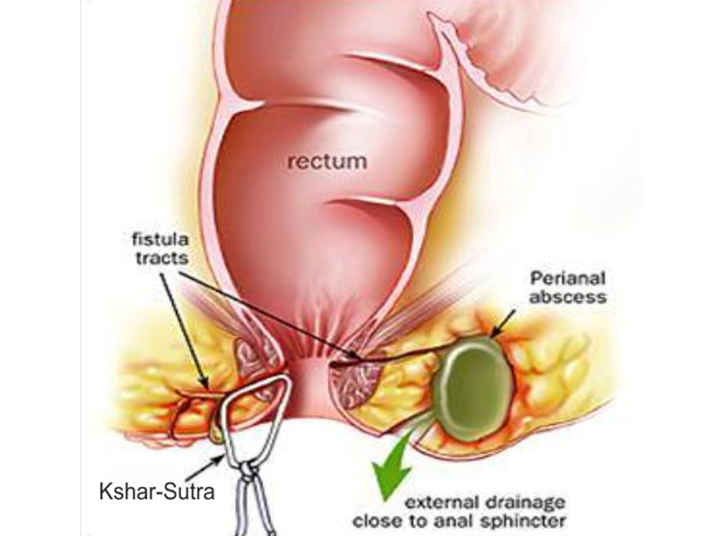 Kshar Sutra's Surgery